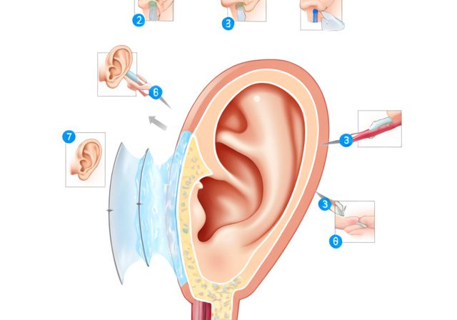 How to Get Water Out of Your Ear After Swimming