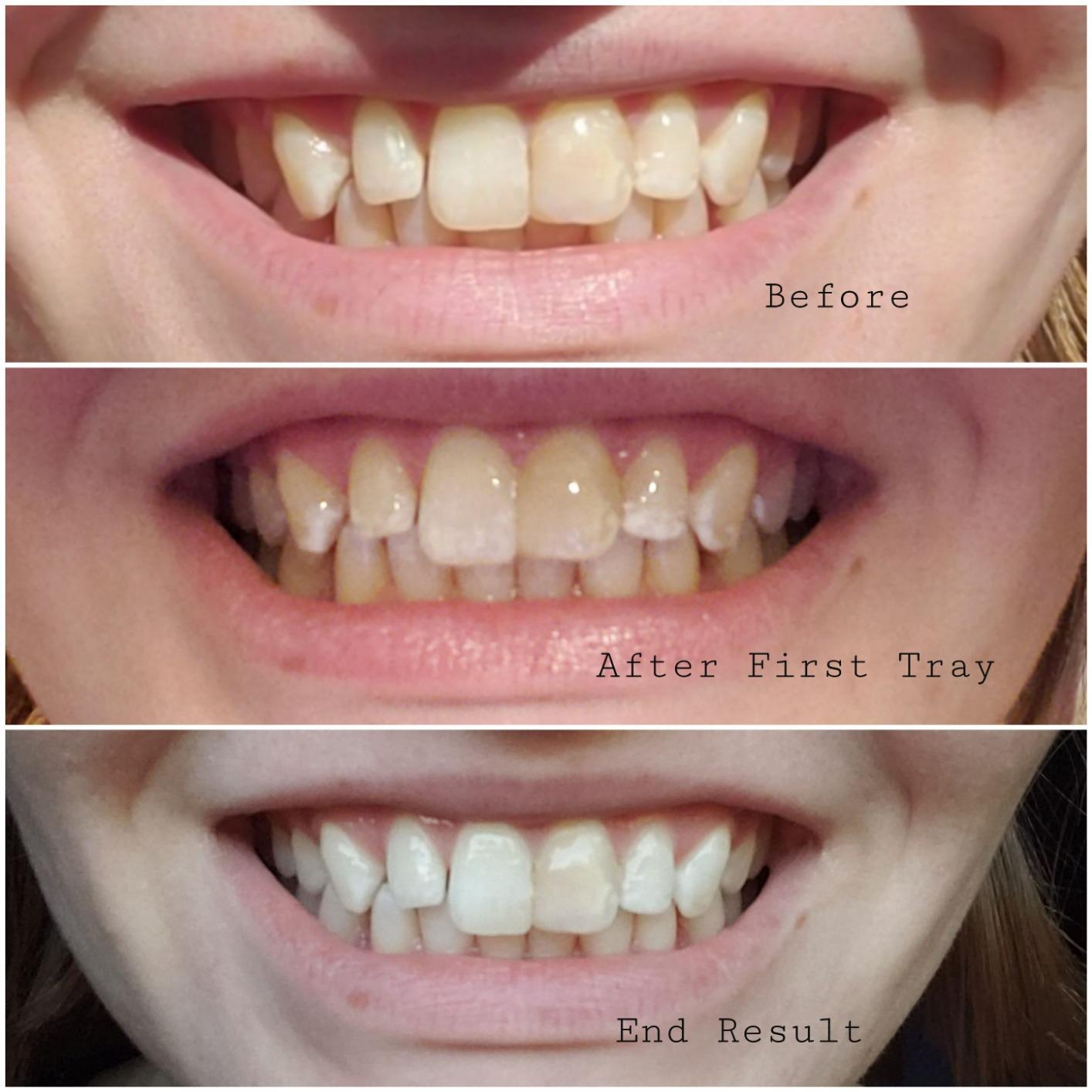 Opalescence Go 15- Prefilled Teeth Whitening Trays - 15% Hydrogen Peroxide - (10 Treatments) Made by Ultradent Products. Teeth Whitening Kit -Mint - 5194-1 customer photo 1
