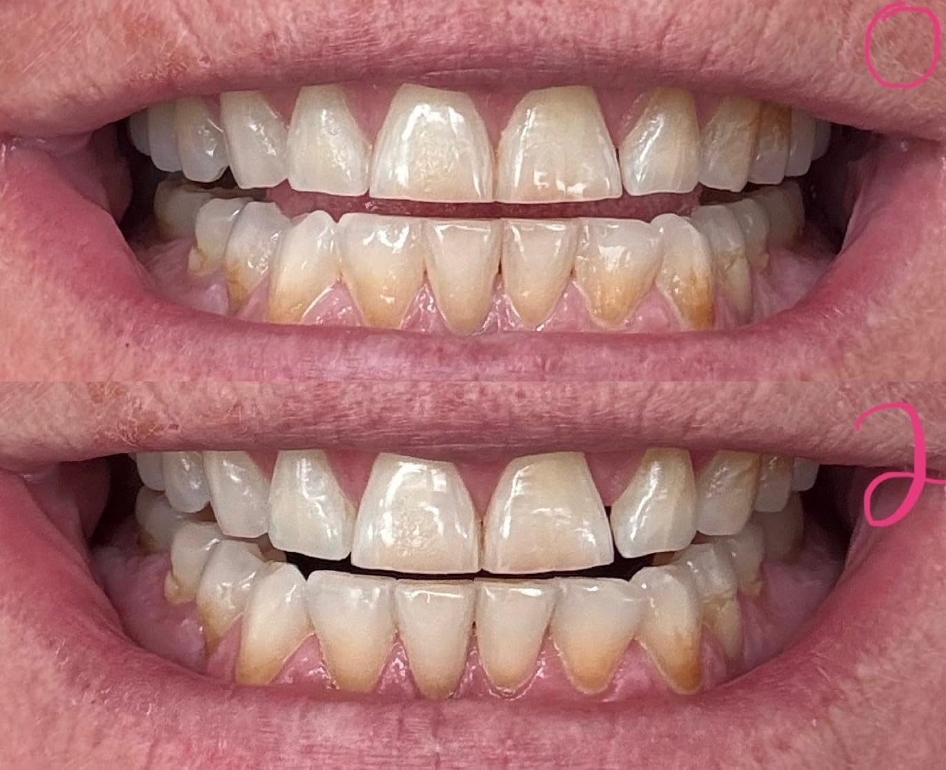 Auraglow 44% Teeth Whitening Gel for Trays, Retainers & Aligners - Dentist Strength Carbamide Peroxide Whitener, 30 Treatments, 3 Syringes (5mL) customer photo 1