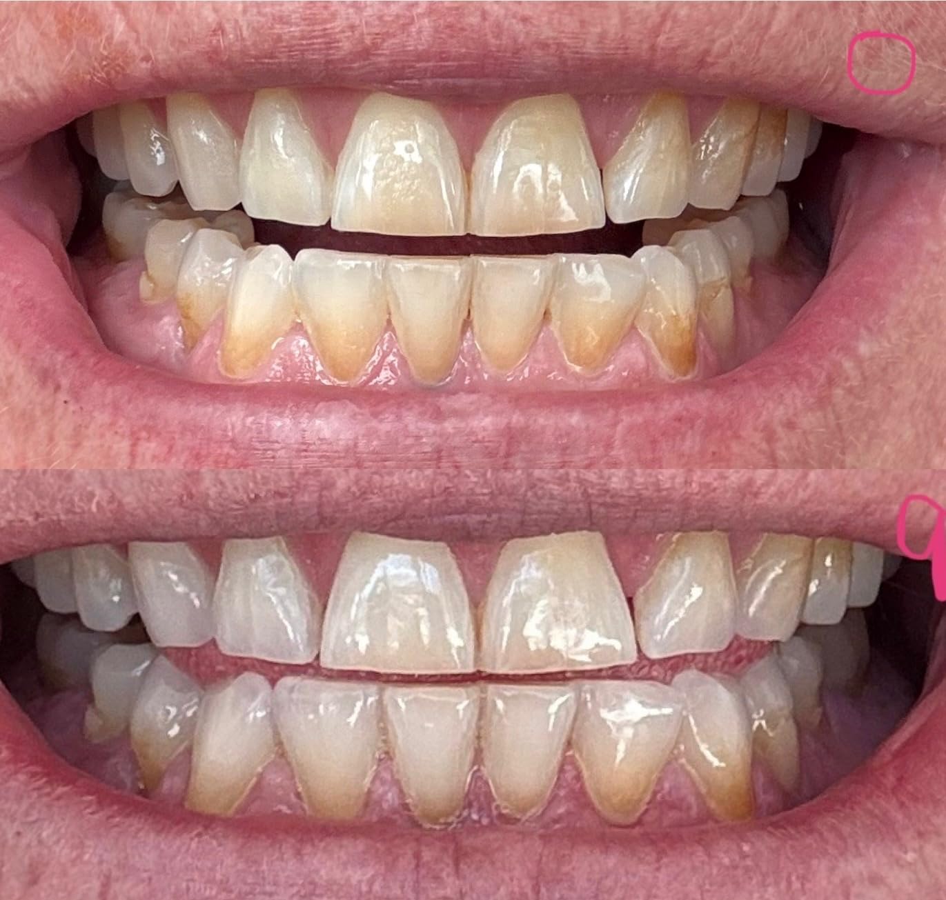 Auraglow 44% Teeth Whitening Gel for Trays, Retainers & Aligners - Dentist Strength Carbamide Peroxide Whitener, 30 Treatments, 3 Syringes (5mL) customer photo 2