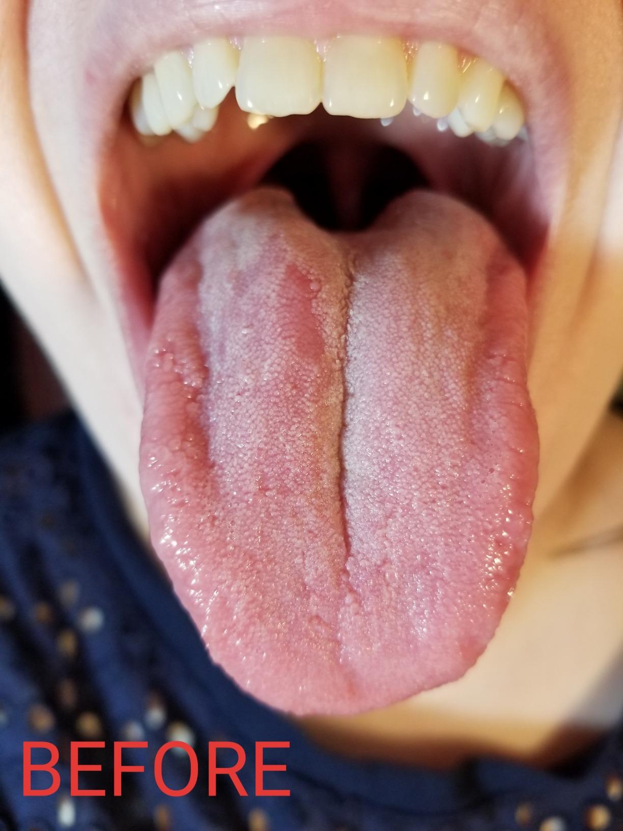 DenTek Orabrush Tongue Scraper, Gentle Tongue Cleaner Brush for Fresh Breath, 2 Count customer photo 2