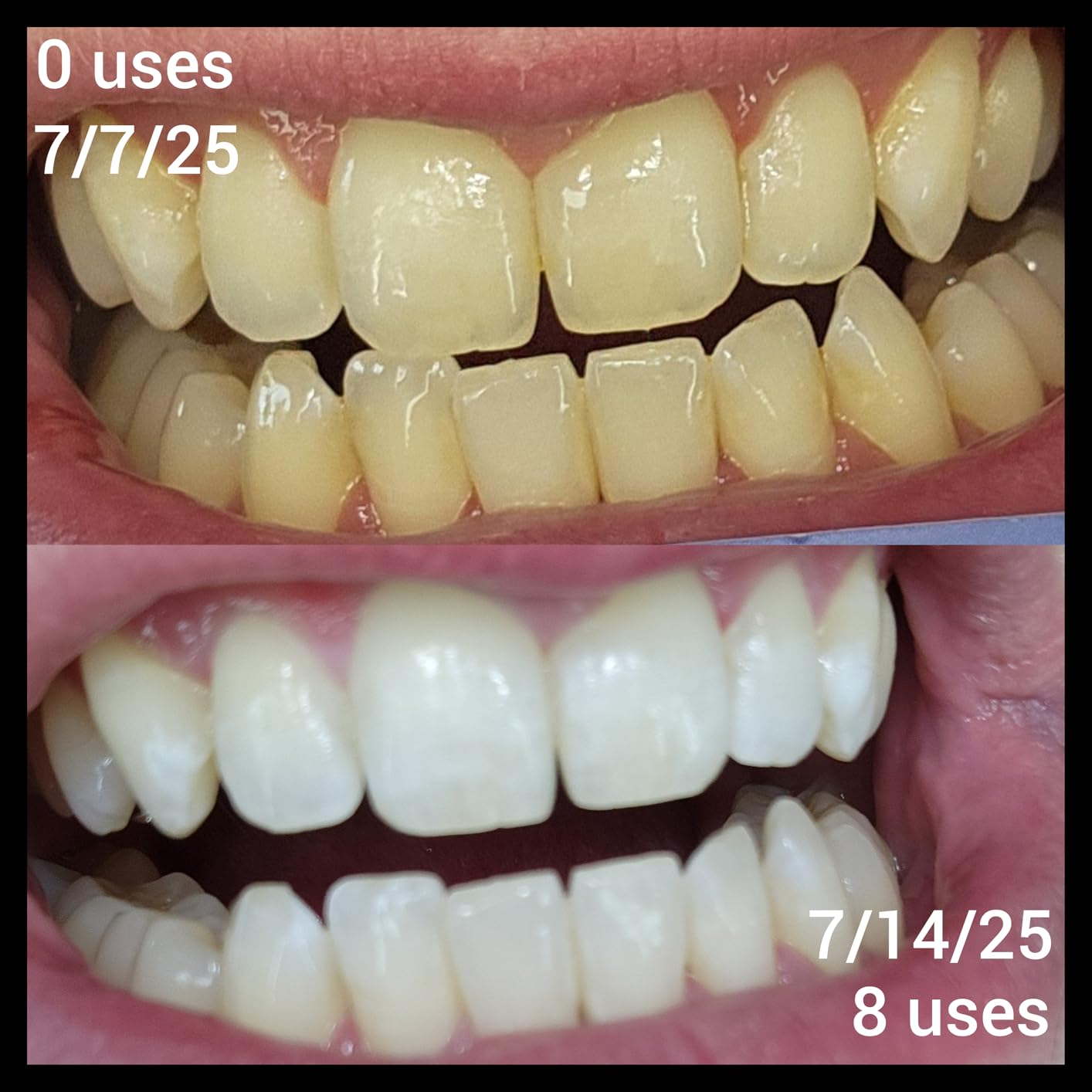 iSmile Teeth Whitening Kit - LED Light, 35% Carbamide Peroxide, (3) 3ml Gel Syringes, (1) Remineralization Gel, and Tray. customer photo 2