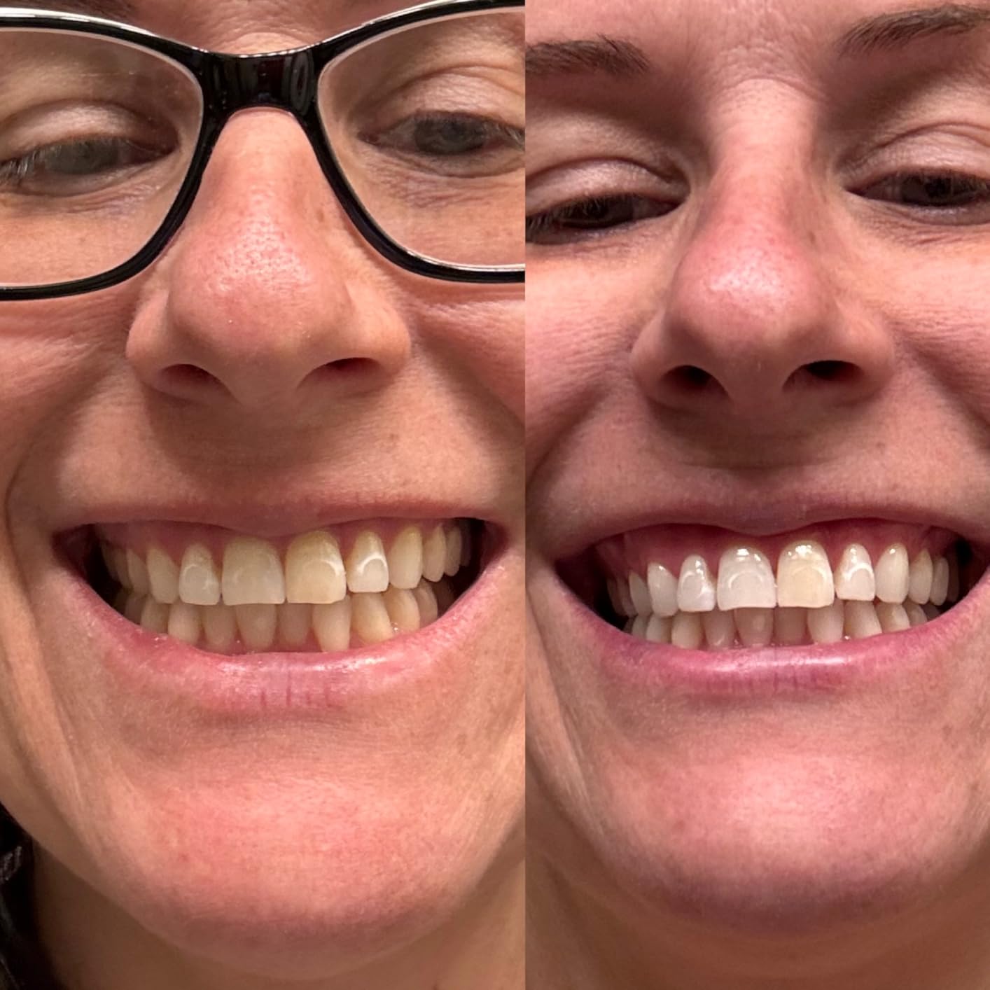 Lumineux Teeth Whitening Strips - 21 Treatments (3 Months) - Peroxide Free - Enamel Safe for Whiter Teeth - Whitening Without The Sensitivity - Dentist Formulated - Sensitivity customer photo 1