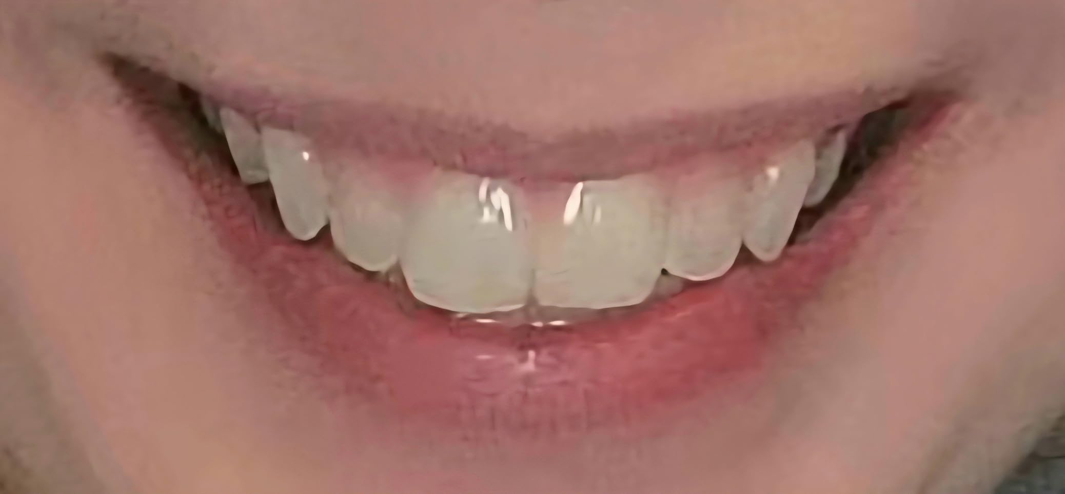 Amazon Basics 10 Day Teeth Whitening Strips Kit, Enamel Safe Formula, Convenient Daily Use, 10 Treatments, 1-Pack (Previously Solimo) customer photo 1