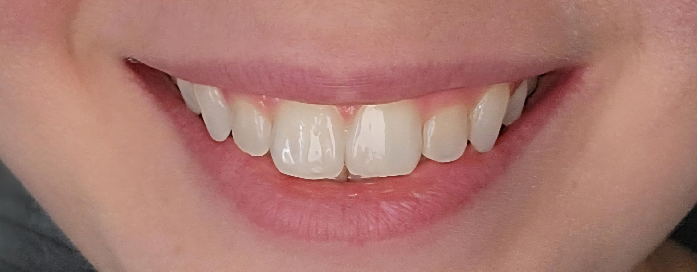Amazon Basics 10 Day Teeth Whitening Strips Kit, Enamel Safe Formula, Convenient Daily Use, 10 Treatments, 1-Pack (Previously Solimo) customer photo 2