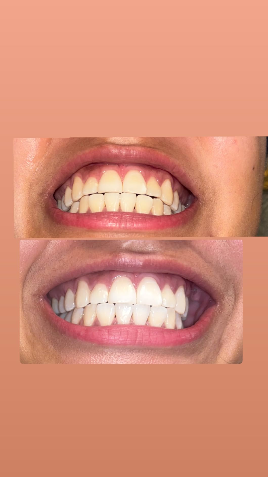 GuruNanda Teeth Whitening Strips - 7-Day Treatment with Non-Slip, Dry Strip Technology - Whitening Designed with Care for a Brighter Smile customer photo 2