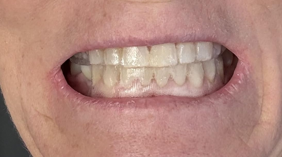 Crest 3D Whitestrips Sensitive White - Teeth Whitening Kit, 18 Treatments, Each with 1 Upper/1Lower, 36 Strips - Crest 3DWhite Teeth Whitening Strips customer photo 1