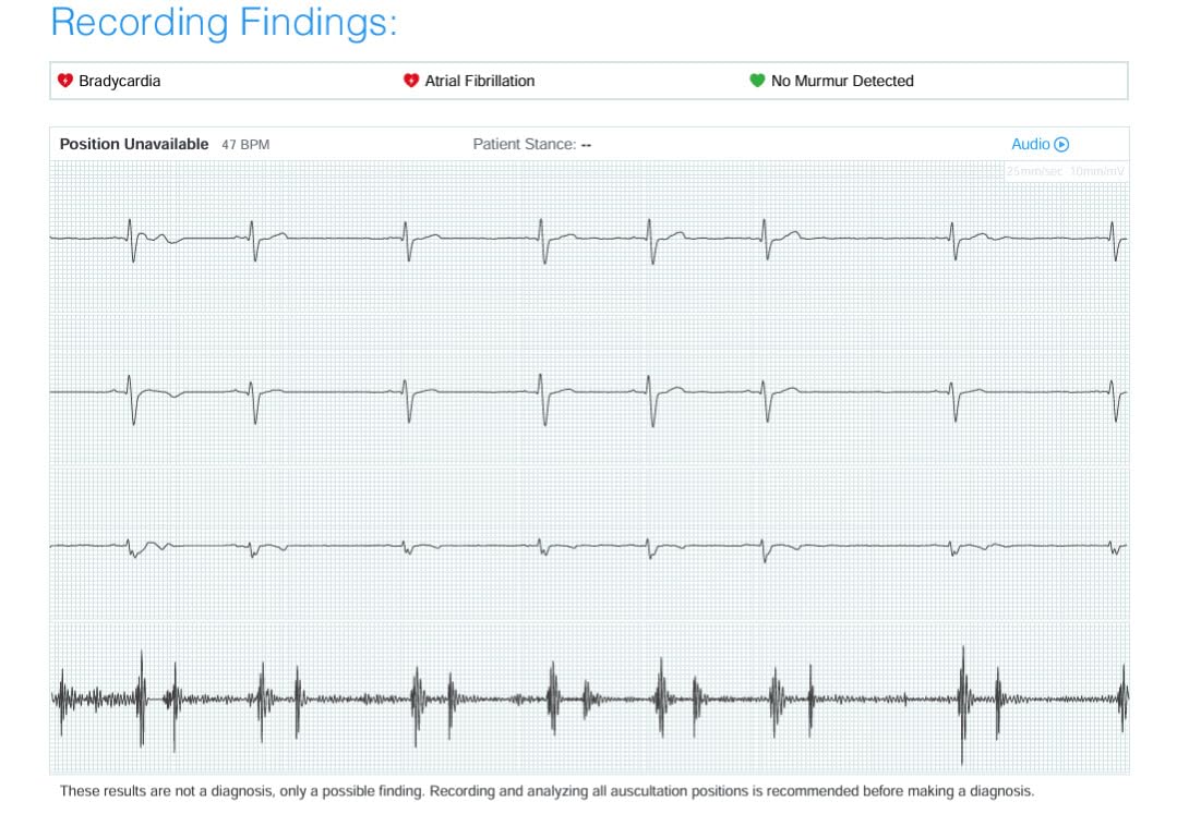 Eko CORE 500 Digital Stethoscope - 40x Amplification, Active Noise Cancellation, 3-Lead ECG, FDA-Cleared AI with Eko+, Full-Color Display - Matte Black customer photo 2