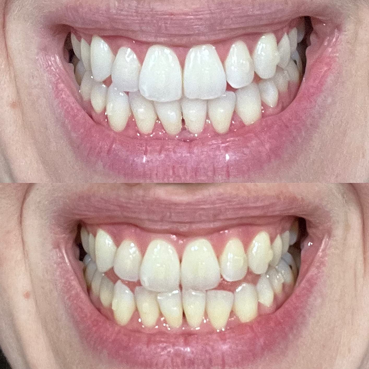 Whitebite Pro Teeth Whitening Kit for Sensitive Teeth | 4 Whitening Gels & 2 Remineralizing Gels | LED Light System for Fast Results | Professional Dental Grade | Enamel Safe customer photo 2