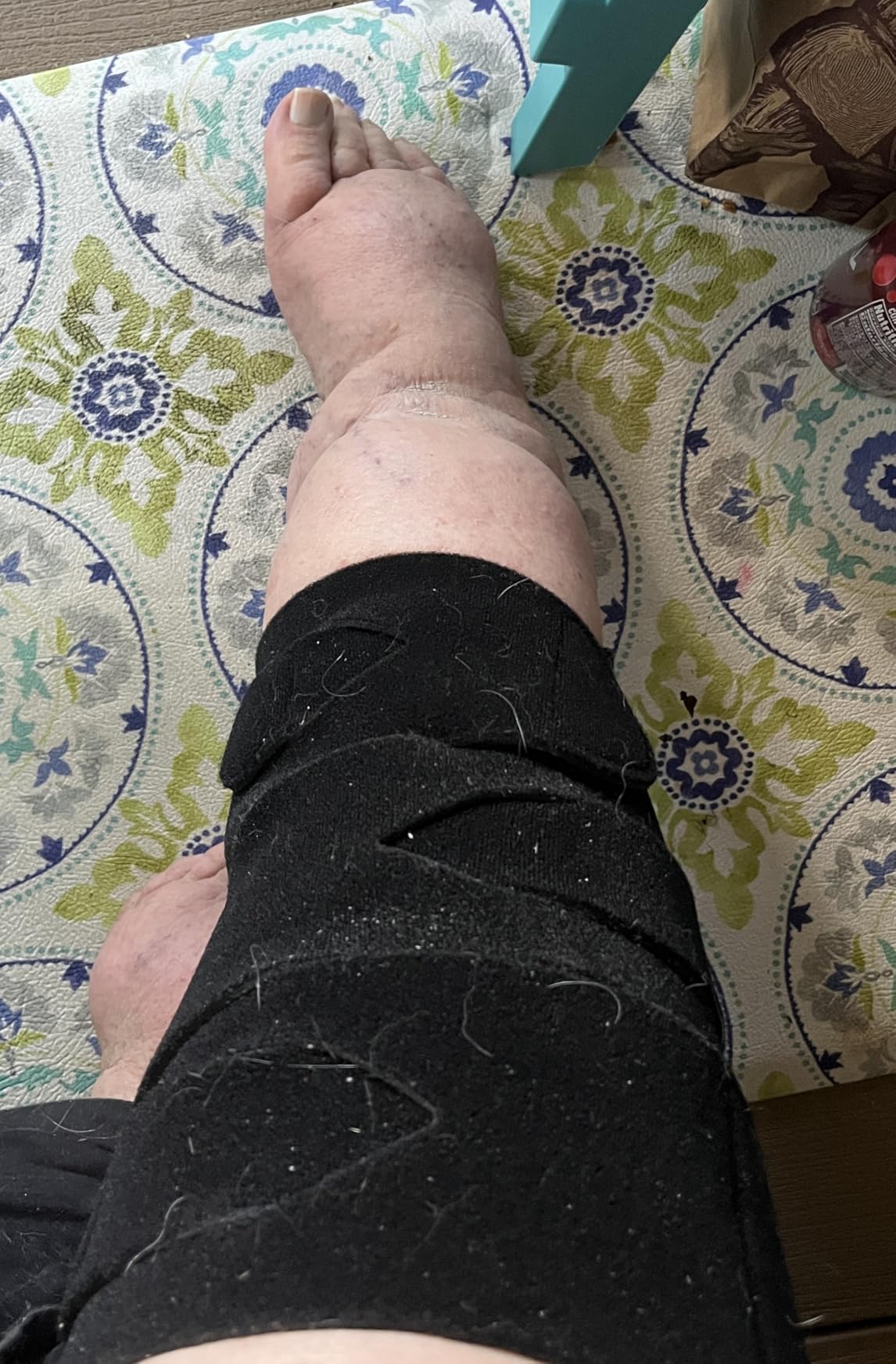 iDonua Calf Lymphedema Compression Wrap Adjustable For Big Swollen Lower Leg - with 6 Cross Straps (Tall-L) customer photo 1