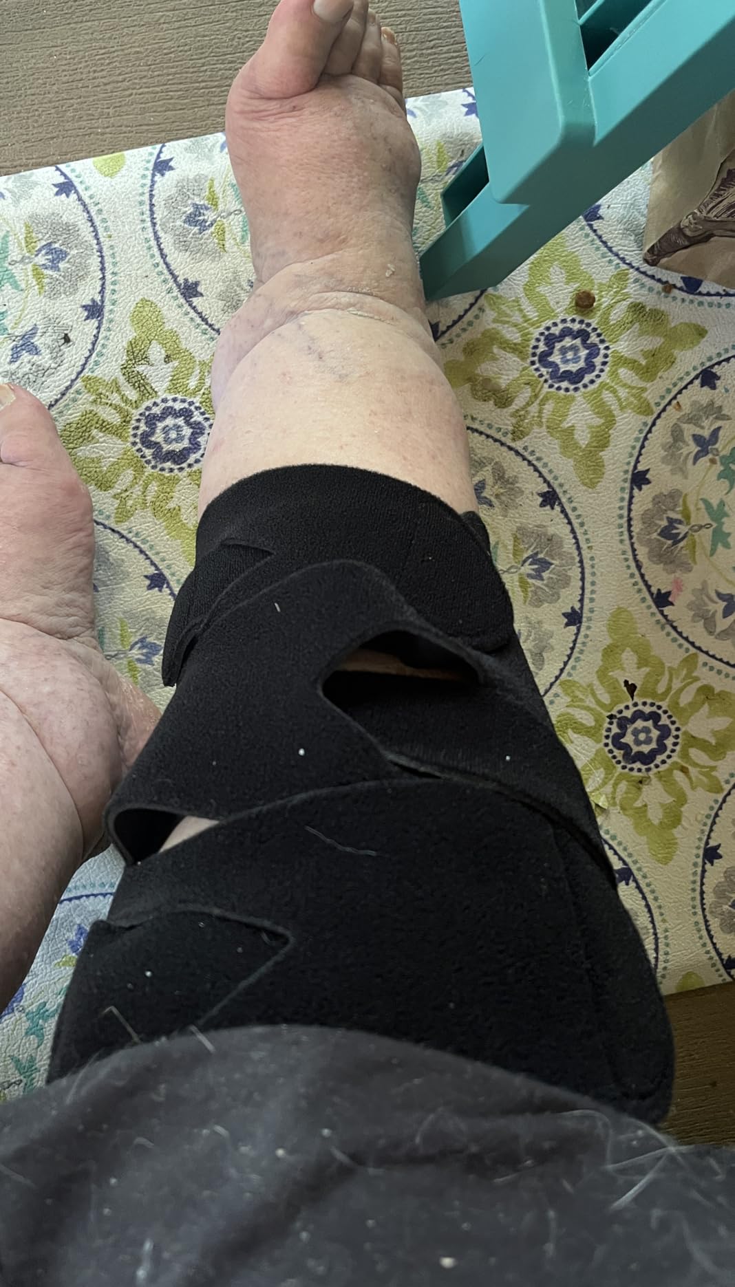 iDonua Calf Lymphedema Compression Wrap Adjustable For Big Swollen Lower Leg - with 6 Cross Straps (Tall-L) customer photo 2