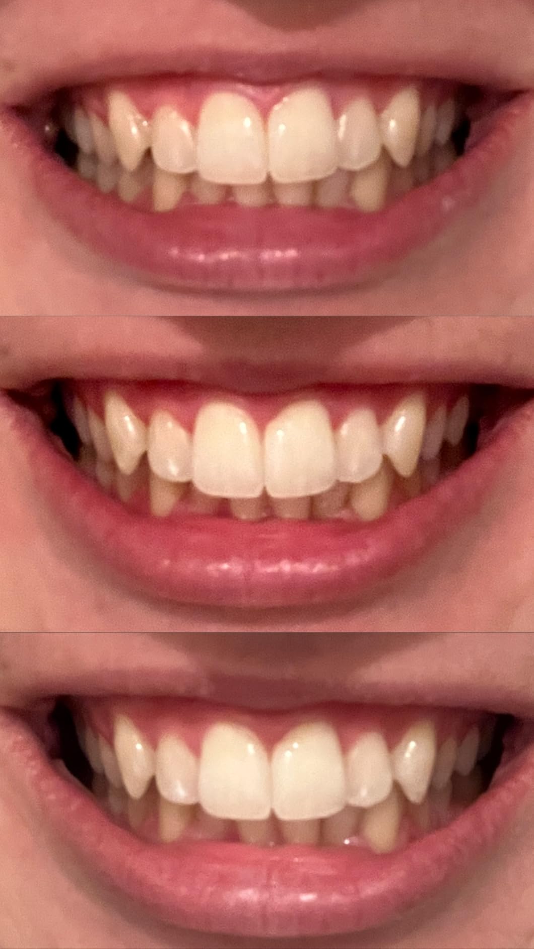 BURST Prefilled Teeth Whitening Trays (6 Trays/3 Treatments) |15% Hydrogen Peroxide for Professional-Level Results | Flexible 360° Teeth Whitening Gel Trays | Aloe, Coconut & Xylitol Blend Teeth Trays customer photo 1