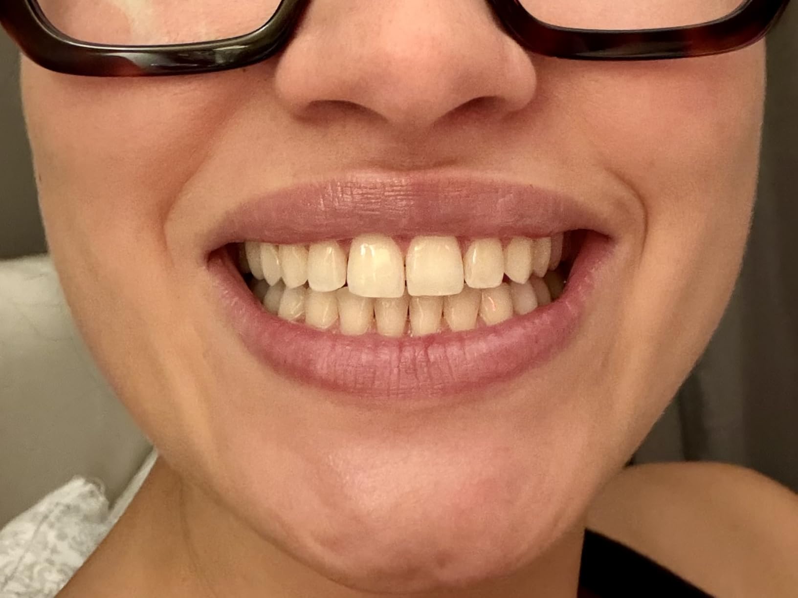 BURST Prefilled Teeth Whitening Trays (6 Trays/3 Treatments) |15% Hydrogen Peroxide for Professional-Level Results | Flexible 360° Teeth Whitening Gel Trays | Aloe, Coconut & Xylitol Blend Teeth Trays customer photo 2
