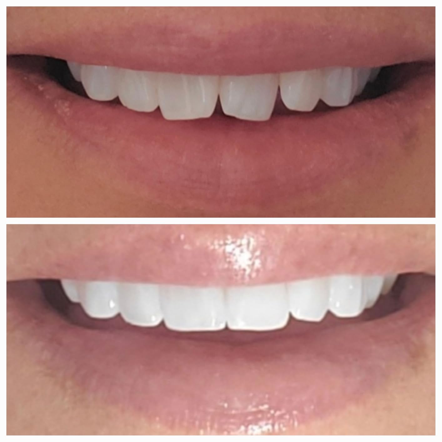 Teeth Whitening Strips for Tooth White: Professional Dentist Formulated Teeth Whitener Enamel-Safe Non-Slip 28 Strips 14 Treatments customer photo 1
