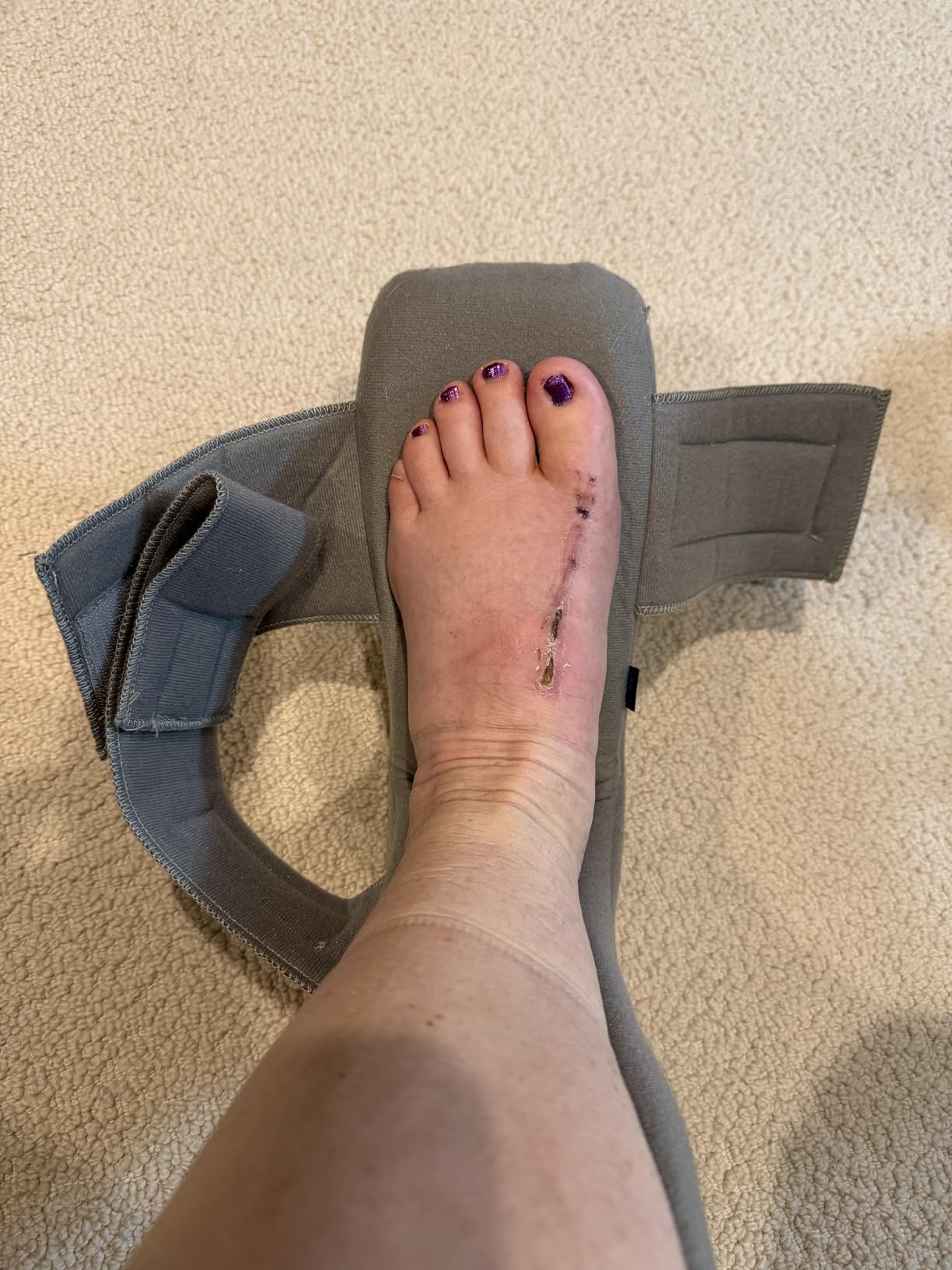 Vive Plantar Fasciitis Night Splint Plus Trigger Point Stretch Wedges - Soft Leg Brace Support, Orthopedic Sleeping Immobilizer Stretch Boot (Medium: Men's: 5.5-8, Women's 7-9.5) customer photo 2