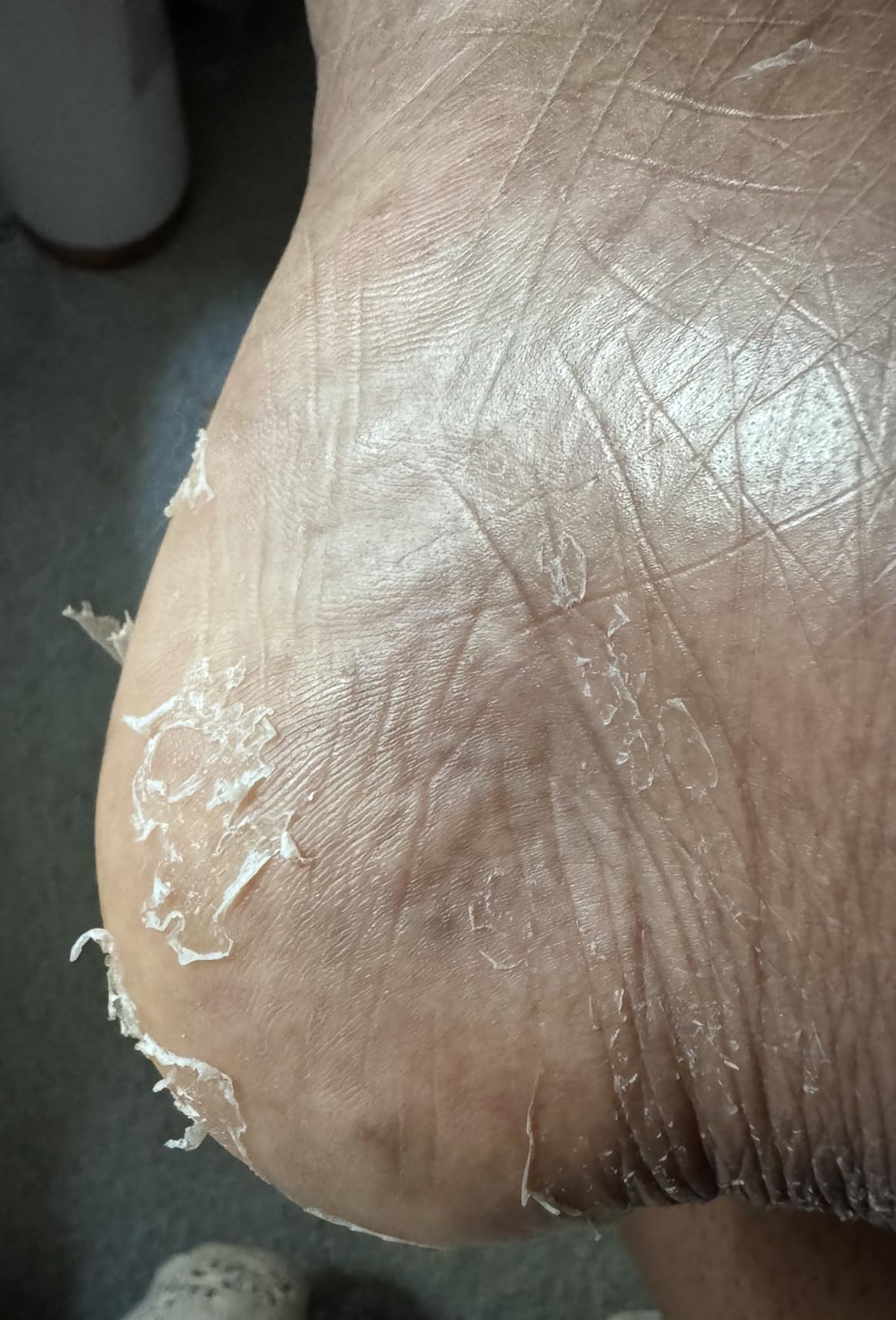 5 Pack Foot Peeling Mask, Exfoliator Peel Off Calluses Dead Skin Callus Remover, Foot Mask for Dry Cracked Feet, Foot Peel Masks for Men and Women customer photo 1