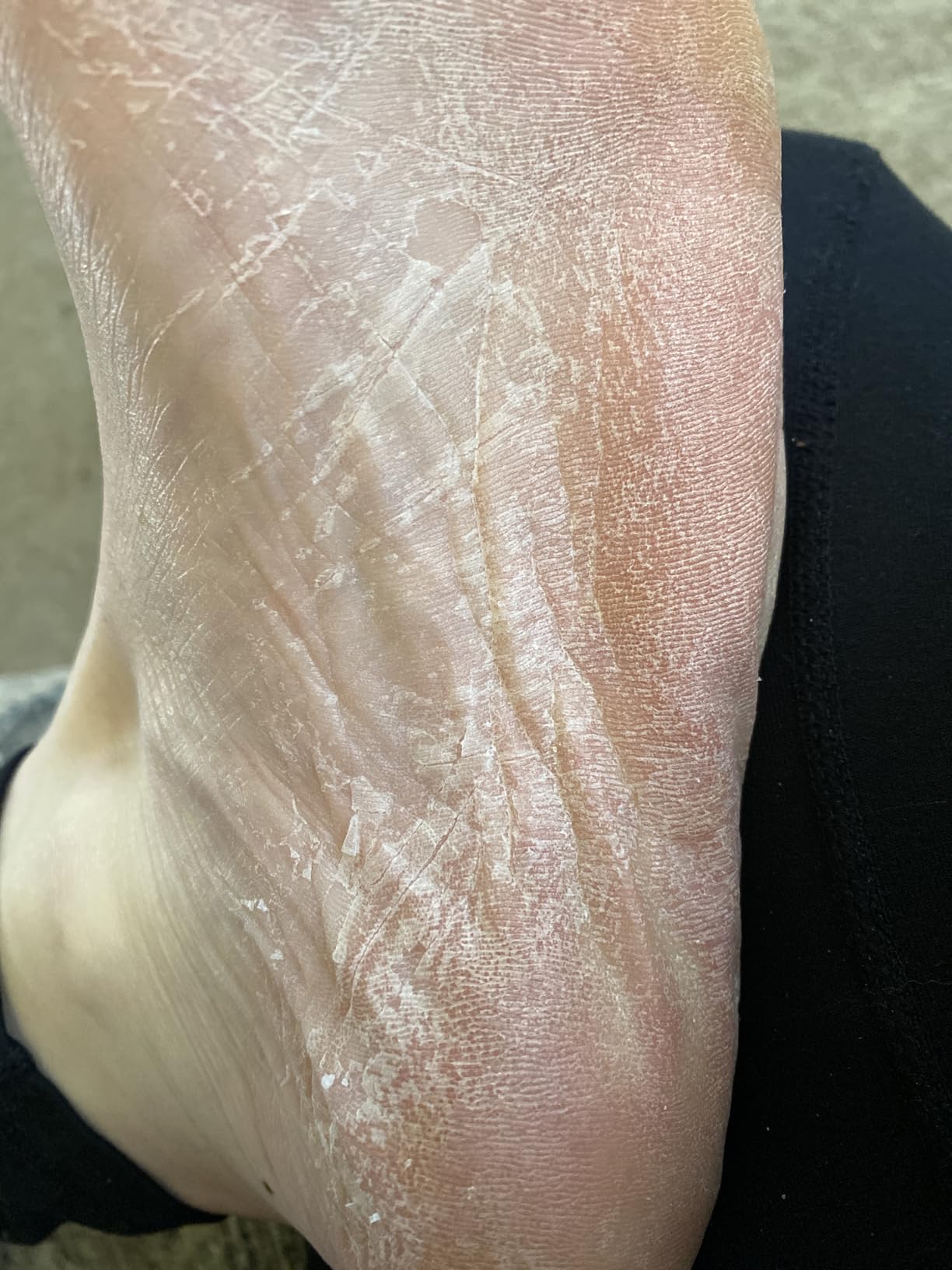 Dr. Scholl's Rough, Dry Skin Ultra Exfoliating Foot Peeling Mask, 3 Pairs Moisturizing Socks Gently Peels and Softens, with Urea, Dry Skin Callus Remover for Feet customer photo 1