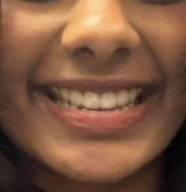 Custom Clear Retainers - Invisible Teeth Retainer for Adults & Teens - Comfortable & Durable Orthodontic Retainer customer photo 2