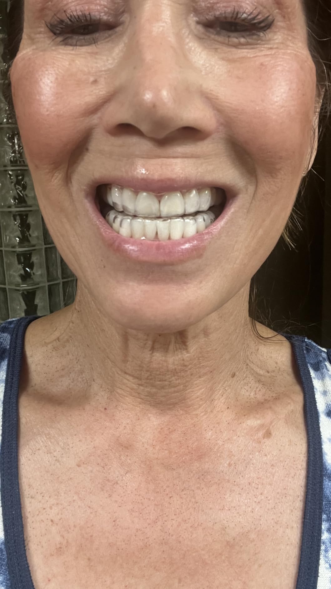 Custom Clear Retainer for Upper or Lower Teeth, BPA & Latex-Free, Invisible and Comfortable Fit for Adults & Teens (Upper or Lower) customer photo 1