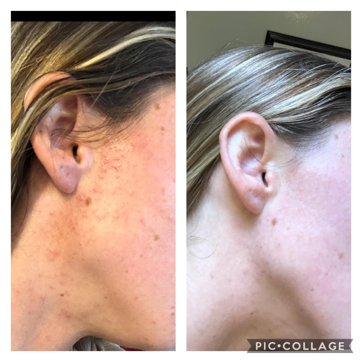 LightStim for Acne LED Red Light Therapy, FDA cleared for mild to moderate acne, reduce acne, calm existing breakouts & restore your skin's healthy appearance 36 Blue & Red LEDs, 415 & 630 wavelengths customer photo 1