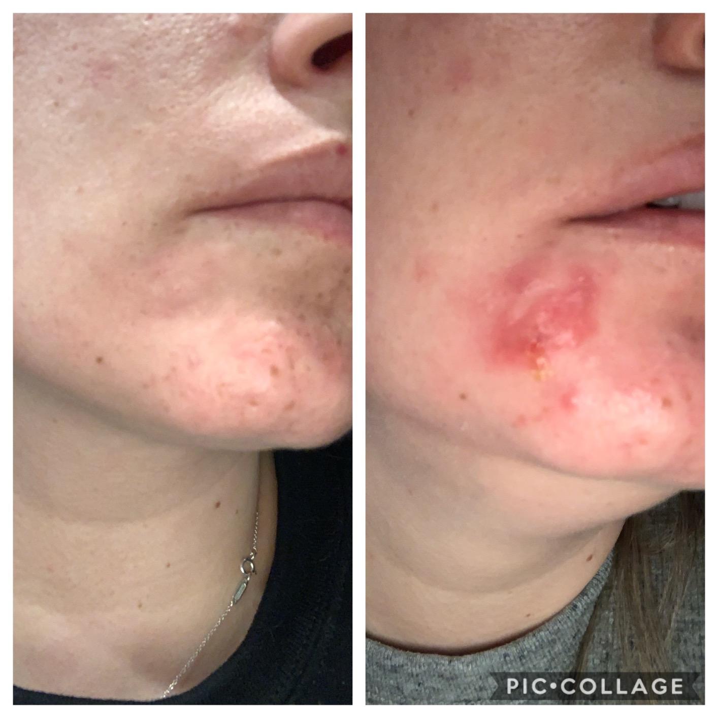 LightStim for Acne LED Red Light Therapy, FDA cleared for mild to moderate acne, reduce acne, calm existing breakouts & restore your skin's healthy appearance 36 Blue & Red LEDs, 415 & 630 wavelengths customer photo 2