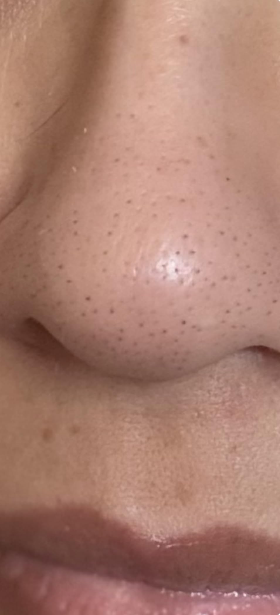 Hero Cosmetics Pore Release Blackhead Clearing Solution, Exfoliating 2% Salicylic Acid Toner Featuring AHA, BHA, and PHA, Blackhead Remover Toner, 100 ml customer photo 1