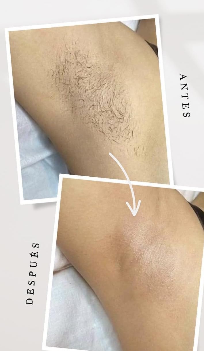 INIA HAUTE Pro Laser Hair Removal with Ice-Cooling Care for Women and Men | Painless at-Home, IPL Hair Remover for Coarse Hair, in Bikini All Body Areas, Latest Generation for Effective Results customer photo 1