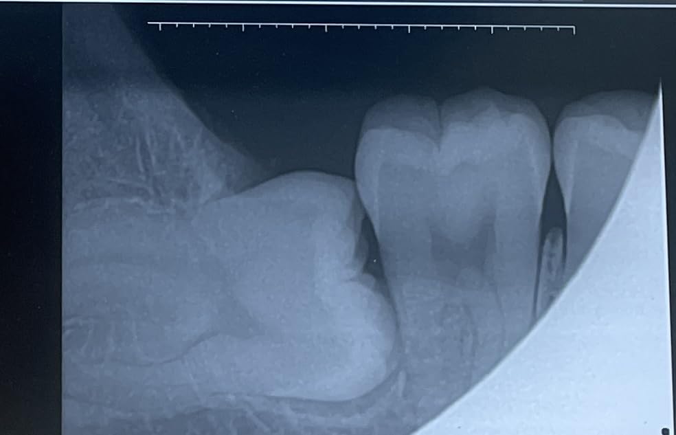 Dental X-Ray Sensor Veterinary Radiovisograph HD Digital Intraoral Imaging System Portable X Ray Digital Sensor (1.5 (25x30mm)) customer photo 1
