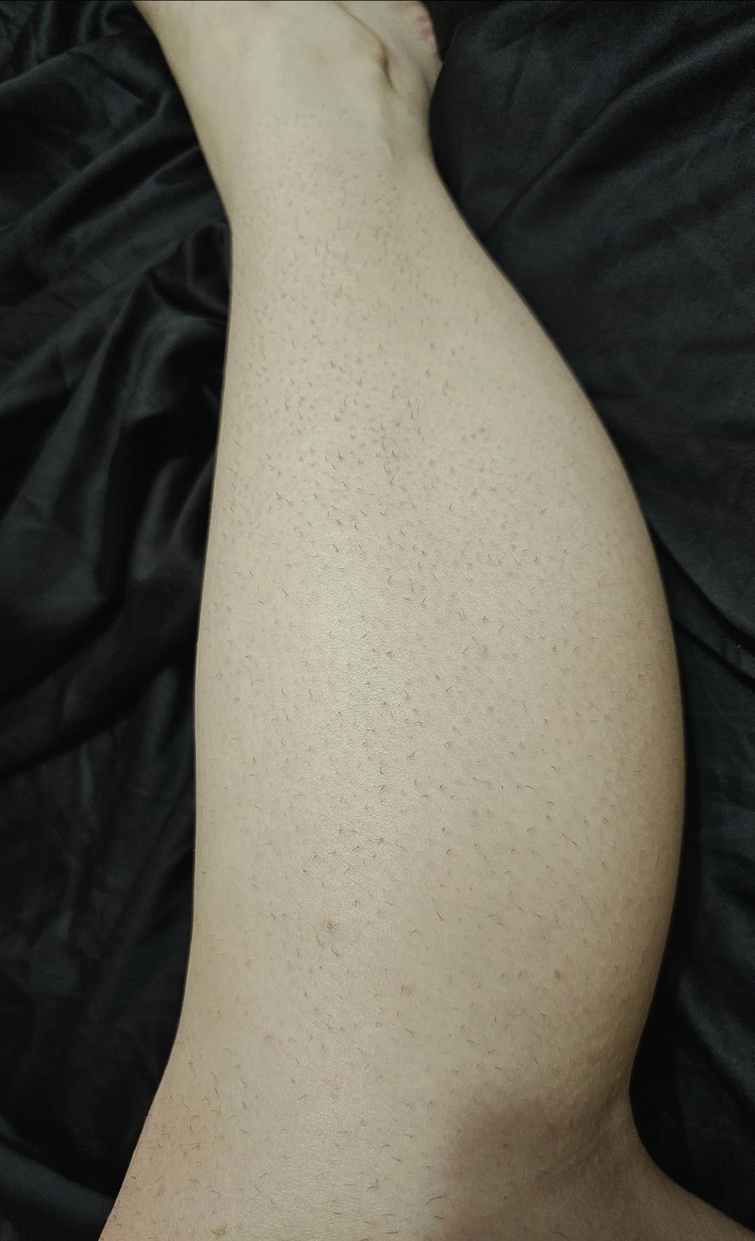 Philips Lumea IPL - Salon-Like Laser Hair Removal for Women, Permanent Hair Reduction Device At Home for Face & Body - Safe & Painless for Face, Bikini, Body, 5 Settings & Skin Sensors, BRI937/03 customer photo 2