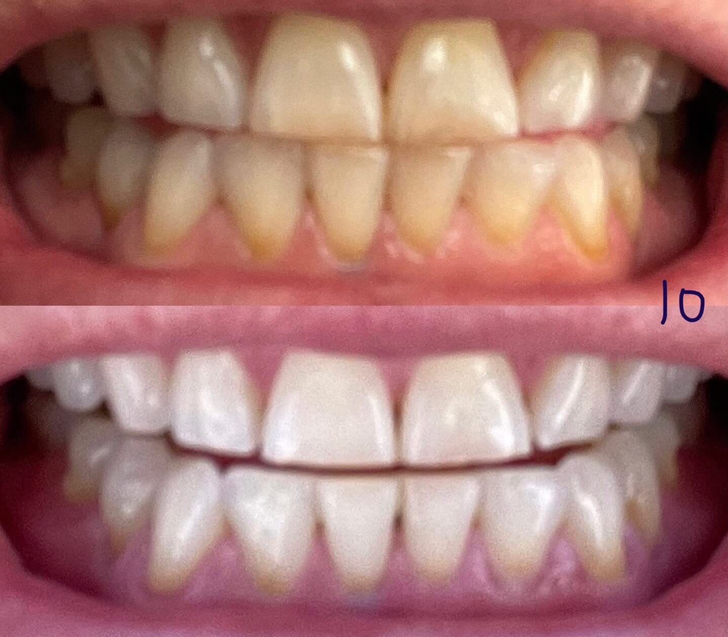 Auraglow Plug-in LED Teeth Whitening Kit - Wired Light Device - 35% Carbamide Peroxide Gel - 12 Treatments - at-Home Tooth Whitening System customer photo 1