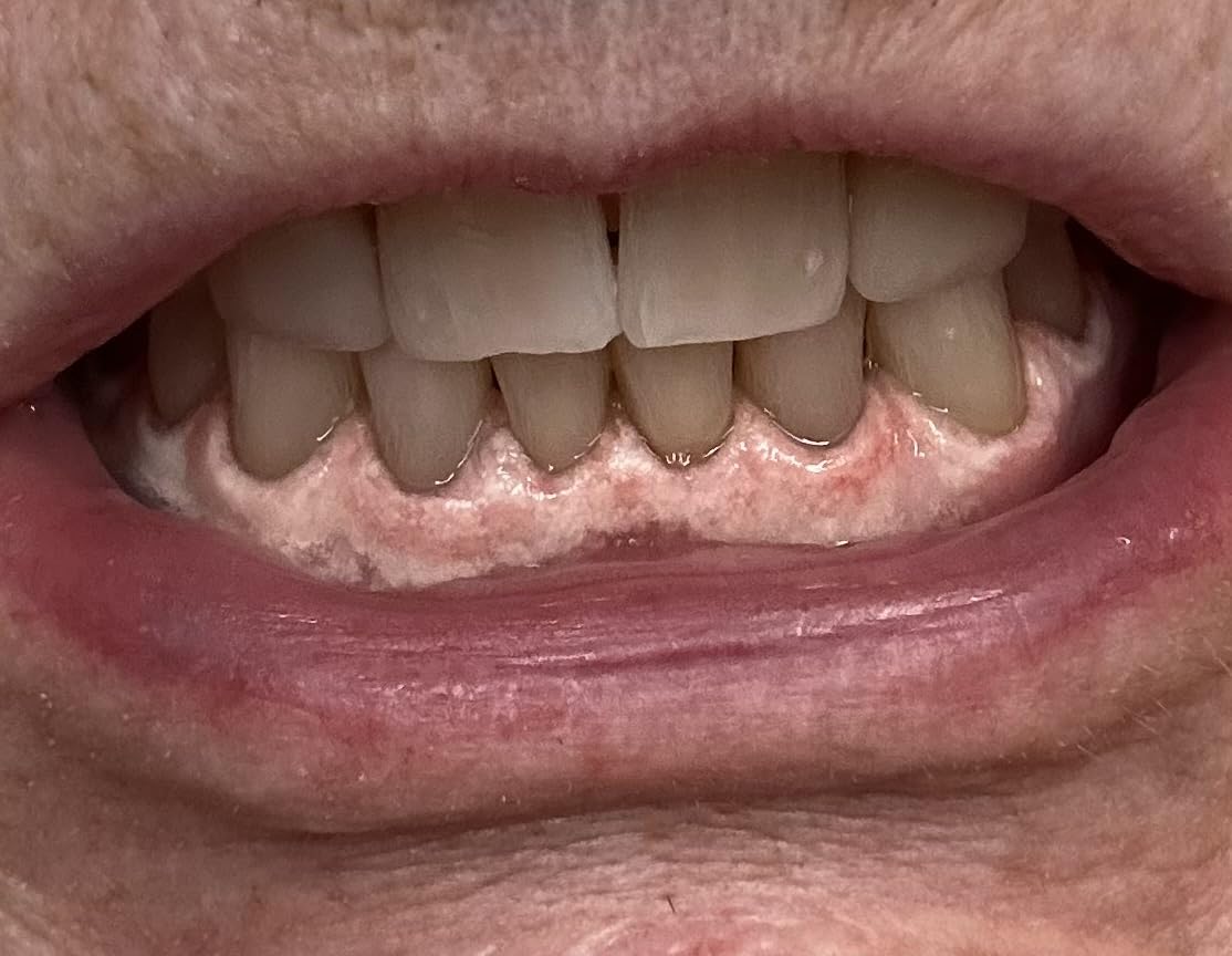 Auraglow Plug-in LED Teeth Whitening Kit - Wired Light Device - 35% Carbamide Peroxide Gel - 12 Treatments - at-Home Tooth Whitening System customer photo 2