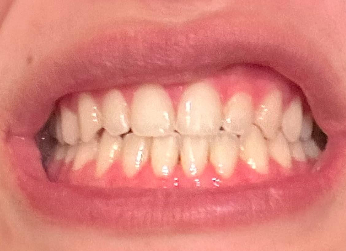 GuruNanda Teeth Whitening Kit, Up to 10 Shades Whitening, 40 Treatments | Wireless LED Accelerator Teeth Whitener | 8% Hydrogen Peroxide Teeth Whitening Gel Pen & Teeth Whitening Strips customer photo 2